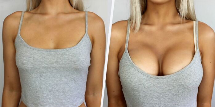 avant et après chirurgie plastique augmentation mammaire