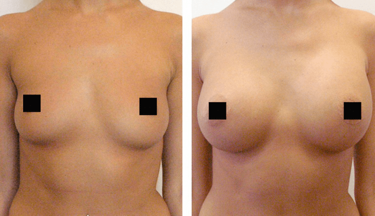sein avant et après augmentation avec de l'acide hyaluronique