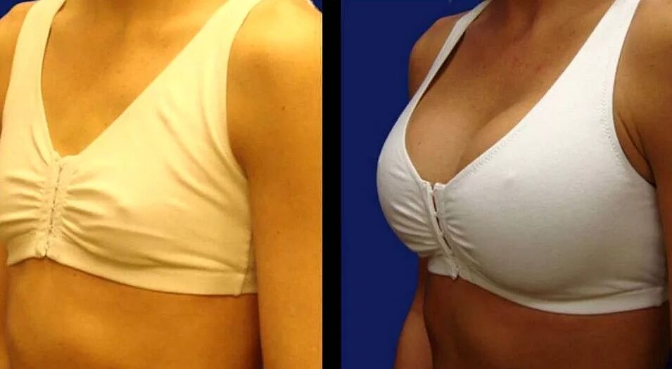 Photo du sein avant et après la chirurgie