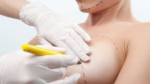 Chirurgie d'augmentation mammaire